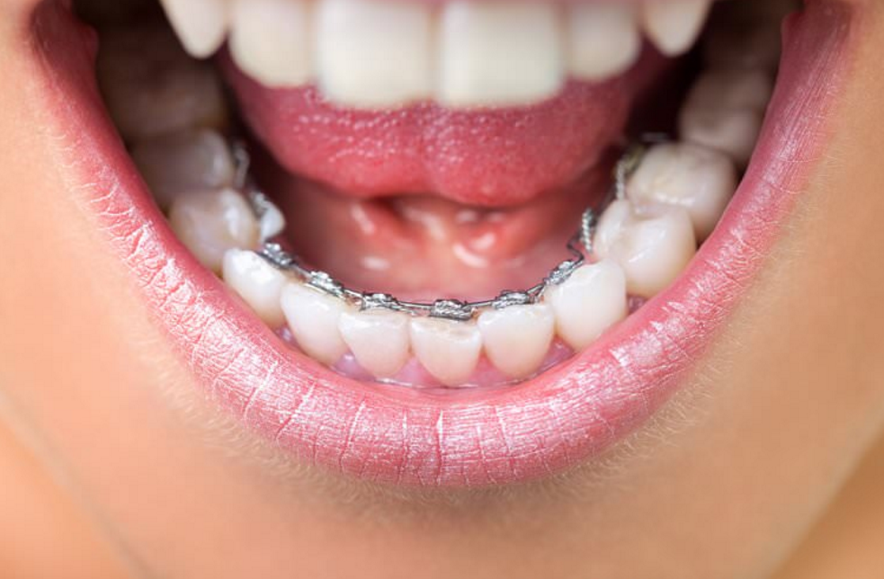 Tout savoir sur l'orthodontie linguale 2
